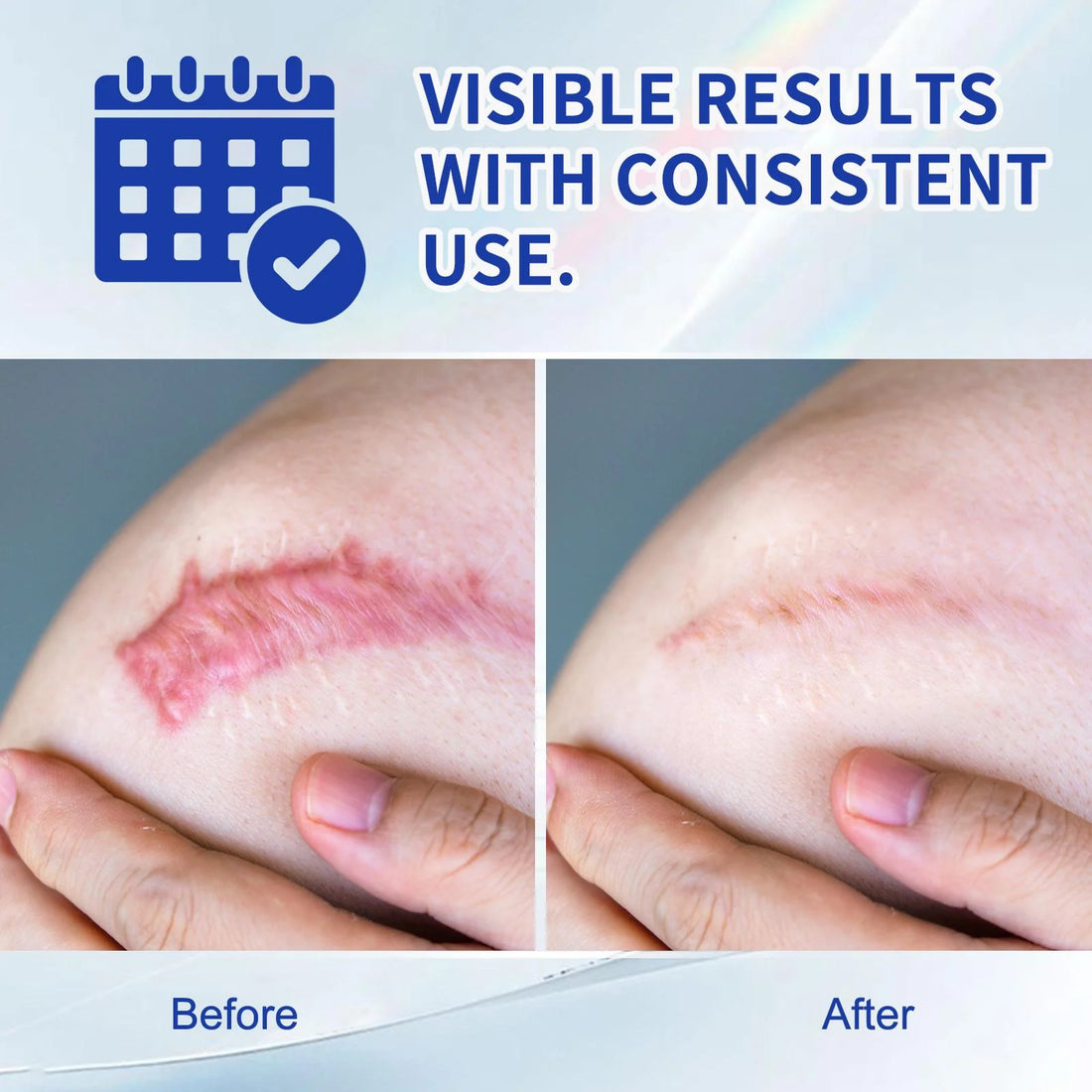 ✨Authentic Silicone Scar Removal Gel – Scar Care Treatment for Smoother-Looking Skin